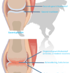 Je zal het maar hebben….. Artrose